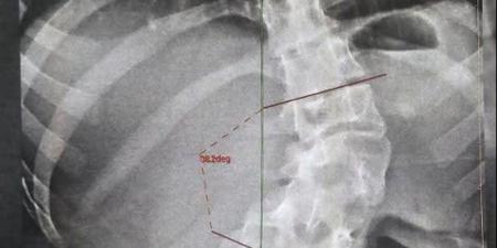 تصحيح شبه كامل لتشوهات العمود الفقري، نجاح جراحة دقيقة لفتاة بمستشفيات بنها الجامعية - المدينة برس