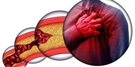 علاجات طبيعية تساعد في خفض الكوليسترول بالدم - المدينة برس