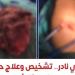 إنجاز طبي نادر، معهد القلب ينجح في تشخيص وعلاج أول حالة موثقة عالميًا لبطانة الرحم داخل الرئة - المدينة برس