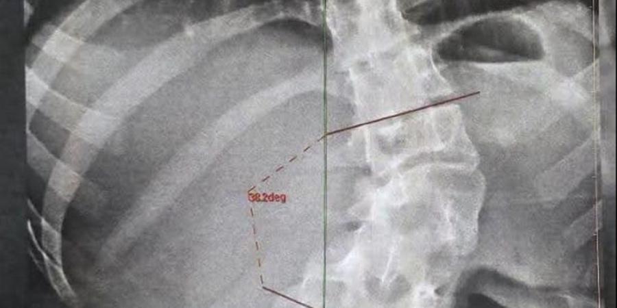 تصحيح شبه كامل لتشوهات العمود الفقري، نجاح جراحة دقيقة لفتاة بمستشفيات بنها الجامعية - المدينة برس