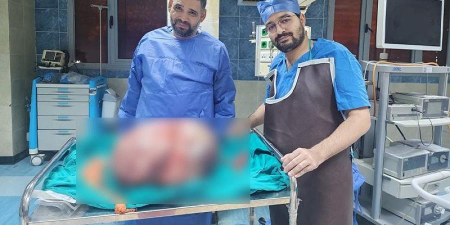 فريق طبي بجامعة المنيا يستأصل ورما يزن 24 كيلو جراما من مبيض سيدة - المدينة برس