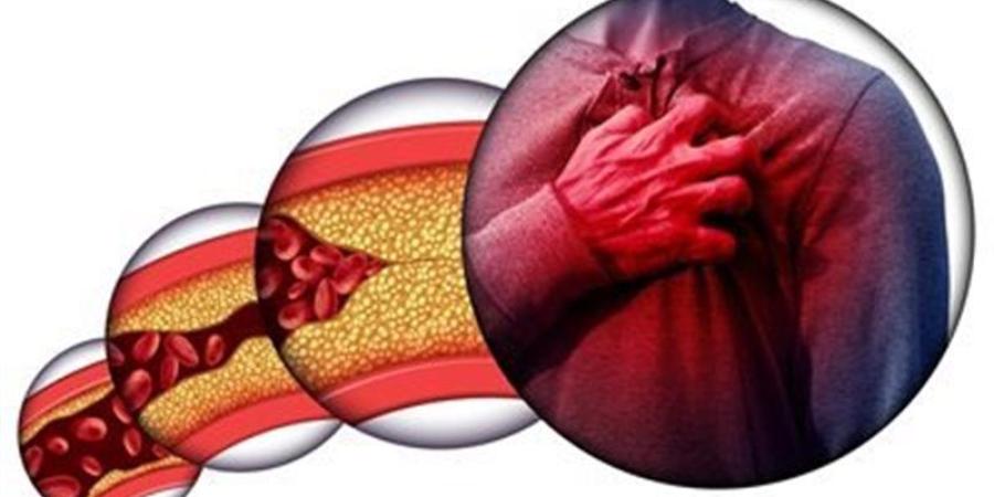 علاجات طبيعية تساعد في خفض الكوليسترول بالدم - المدينة برس