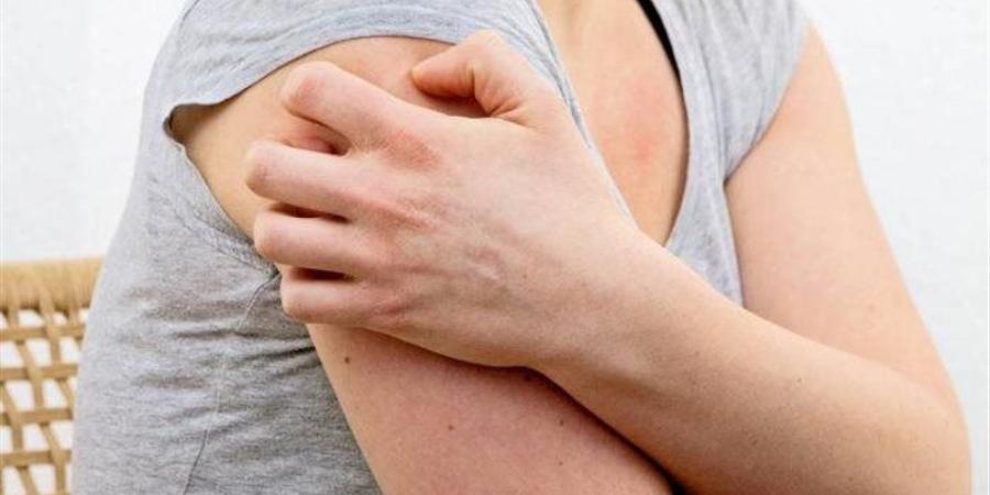أسباب وأعراض إلتهاب الغدد العرقية القيحي وطرق العلاج والوقاية - المدينة برس