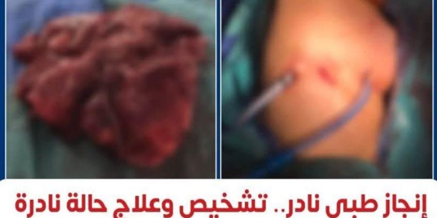 إنجاز طبي نادر، معهد القلب ينجح في تشخيص وعلاج أول حالة موثقة عالميًا لبطانة الرحم داخل الرئة - المدينة برس